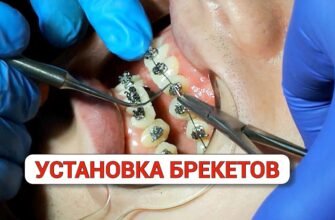 Елайнери: що це таке, як працюють та чому обирають їх для виправлення зубів