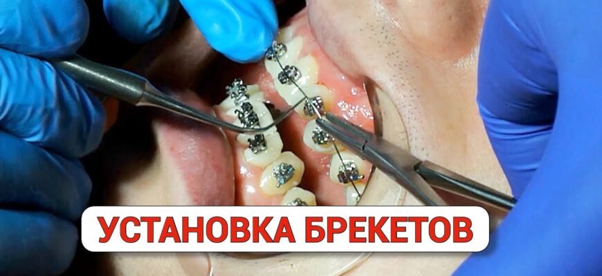 Елайнери: що це таке, як працюють та чому обирають їх для виправлення зубів