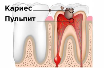 Пульпіт: що це таке, симптоми та методи лікування歯液