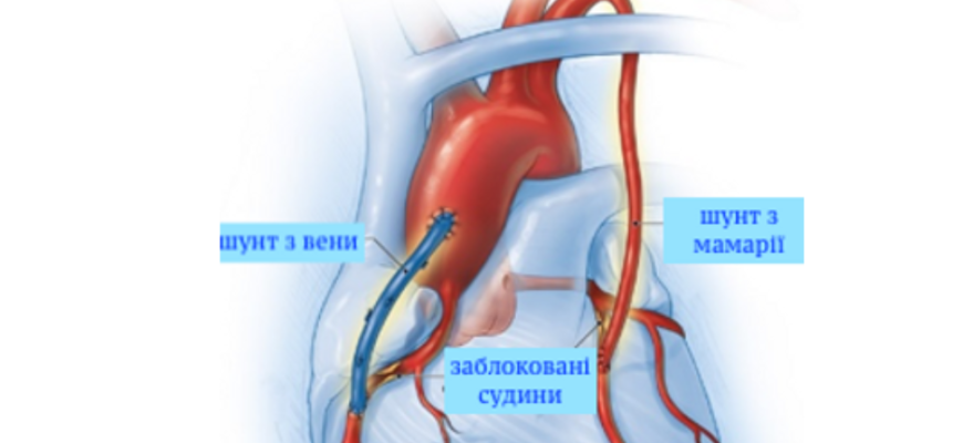 Шунтування серця: Що це таке, коли потрібно і як проходить процедура?