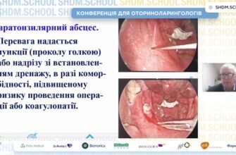 Тонзиліт: визначення, симптоми та методи лікування цього захворювання