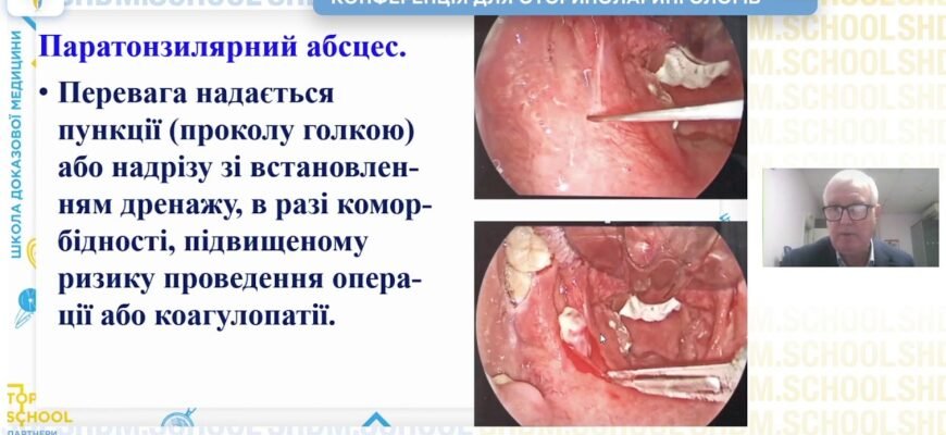 Тонзиліт: визначення, симптоми та методи лікування цього захворювання